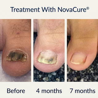 NovaCure®