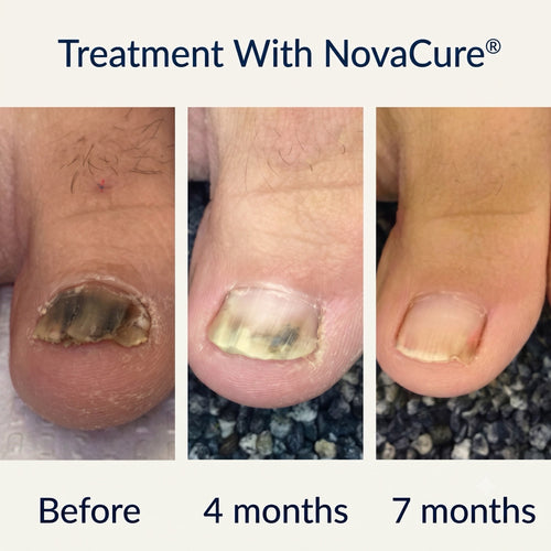 NovaCure®